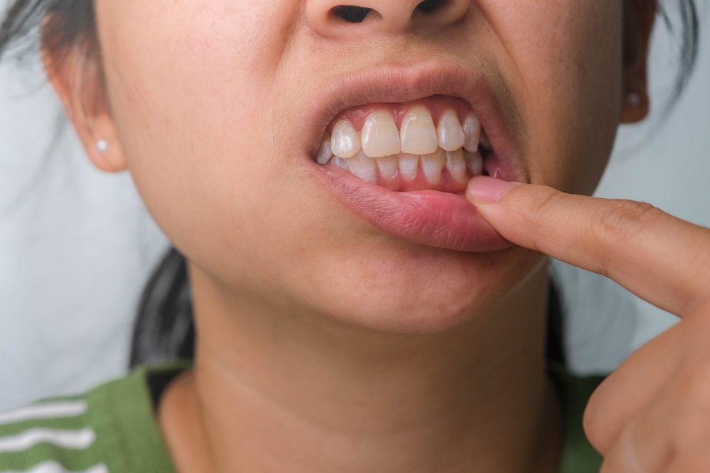 A close up look at a child's teeth. Aura Dental is here to make sure your smile is as bright as ever all year round.